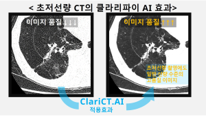 클라리파이, AI 기술로 초저선량 CT 가능성 입증