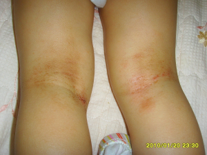 피부완정연구소, 유아아토피의 주된 원인과 올바른 관리법은?