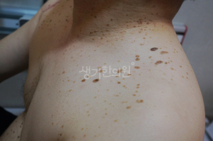 마포사마귀 피부과질환, 재발이 잦은 이유는?