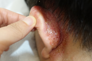 수원지루성피부염 피부과증상, 반복되는 붉은기와 각질 원인 살펴야