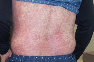 신도림건선 피부과질환, 반복되는 붉은기와 각질 오래 두면 치료 어려워질 수 있다